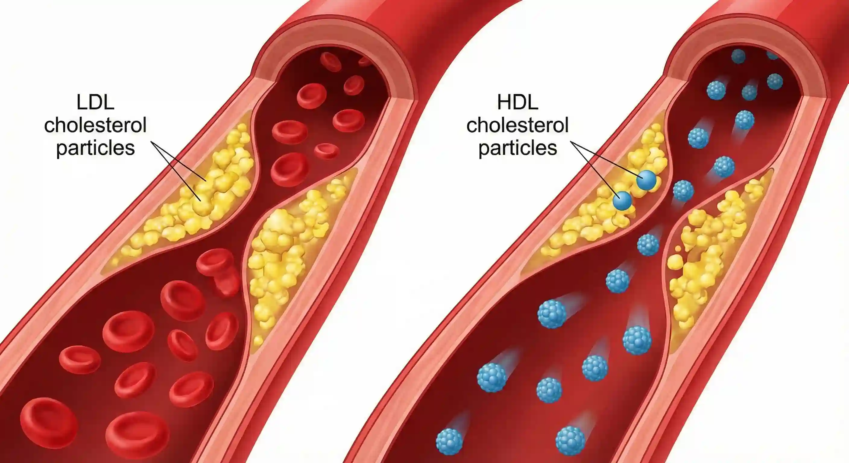 A visual comparison inside an artery showing smooth HDL 'good' cholesterol particles removing clumpy LDL 'bad' cholesterol plaque buildup