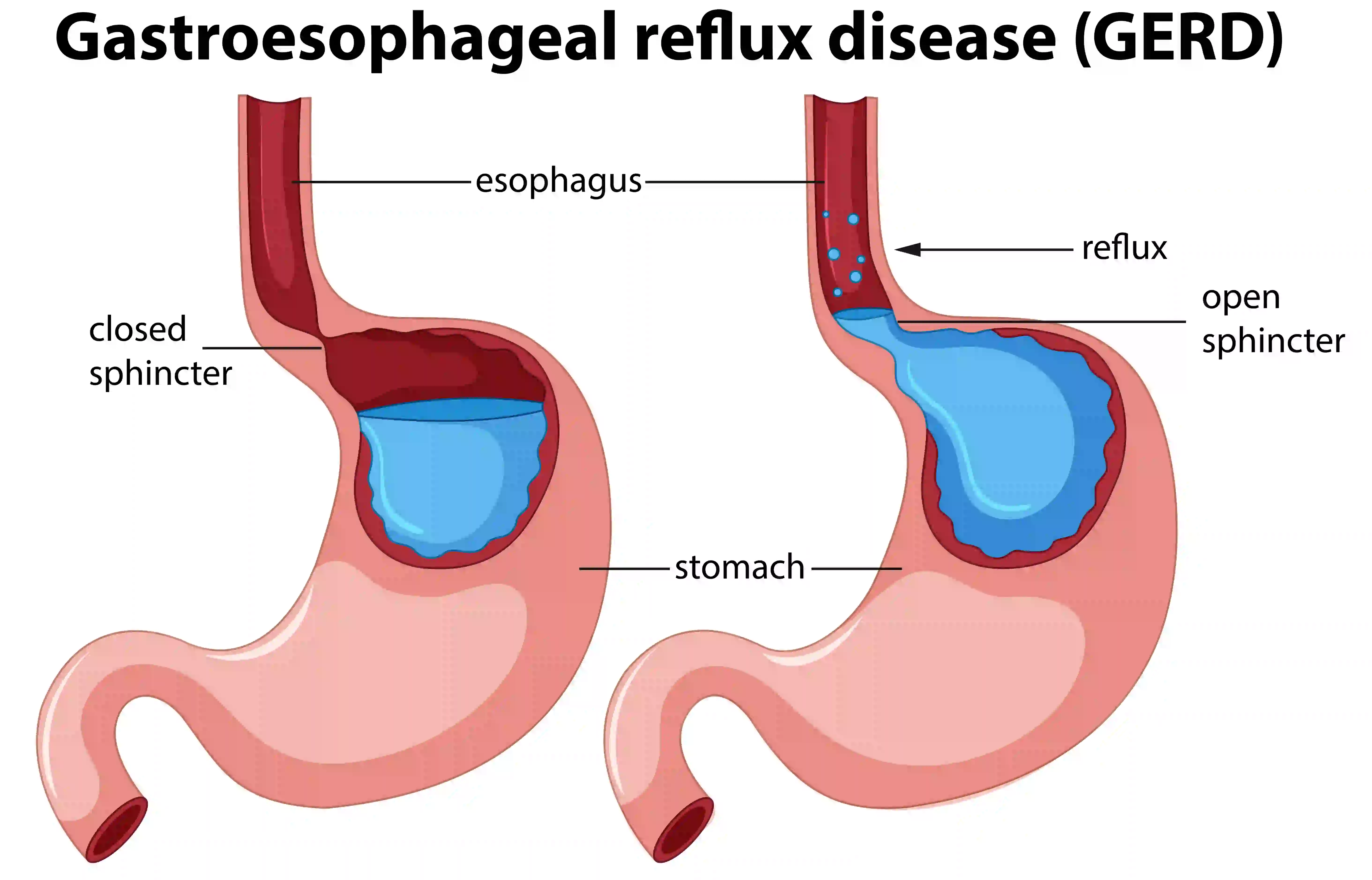 A comparison of a healthy stomach versus one experiencing GERD. Notice how the 'open sphincter' allows stomach acid to escape into the esophagus, causing that familiar burning sensation.